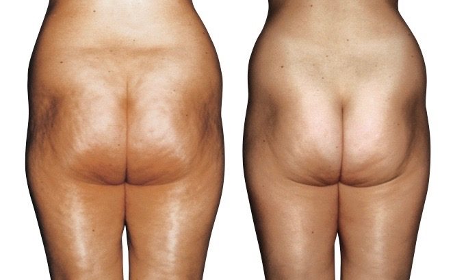 Endermologie photos taken before and after a series of approximately 20 treatments Before and after Endermologie Photos Cellulite