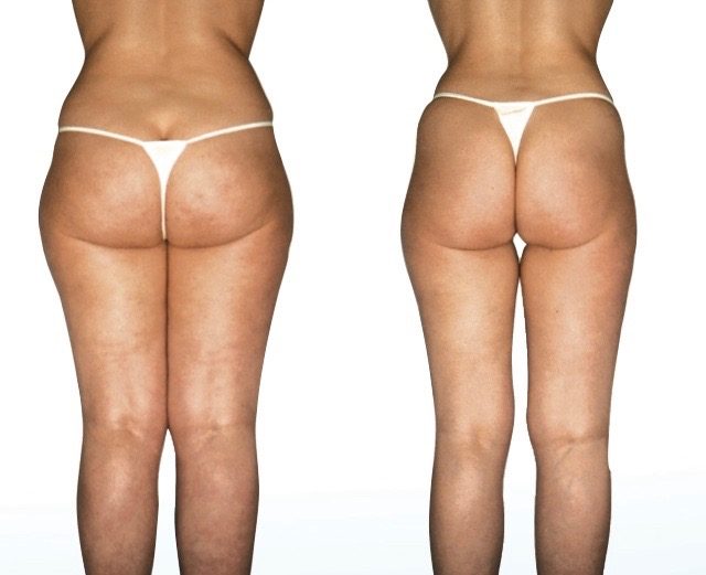Photos taken before and after a series of approximately 20 Endermologie treatments Before and after Endermologie Photos Cellulite & Slimming