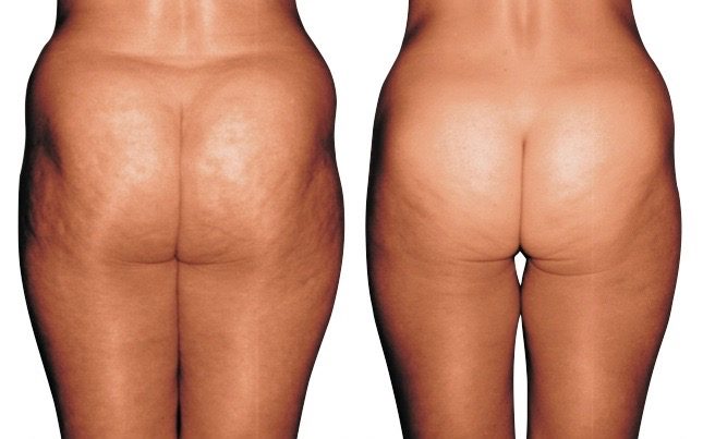 Endermologie before and after photos Before and after Endermologie Photos Cellulite & Slimming