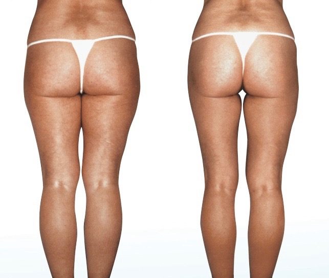 Endermologie before & after photos Before and after Endermologie Photos Body sculpting