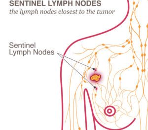 sentinel lymph node