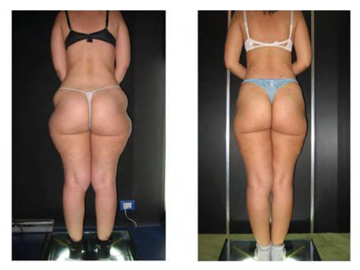 Pre & Post op Endermologie of almost all elective procedures Endermologie pre and post liposuction