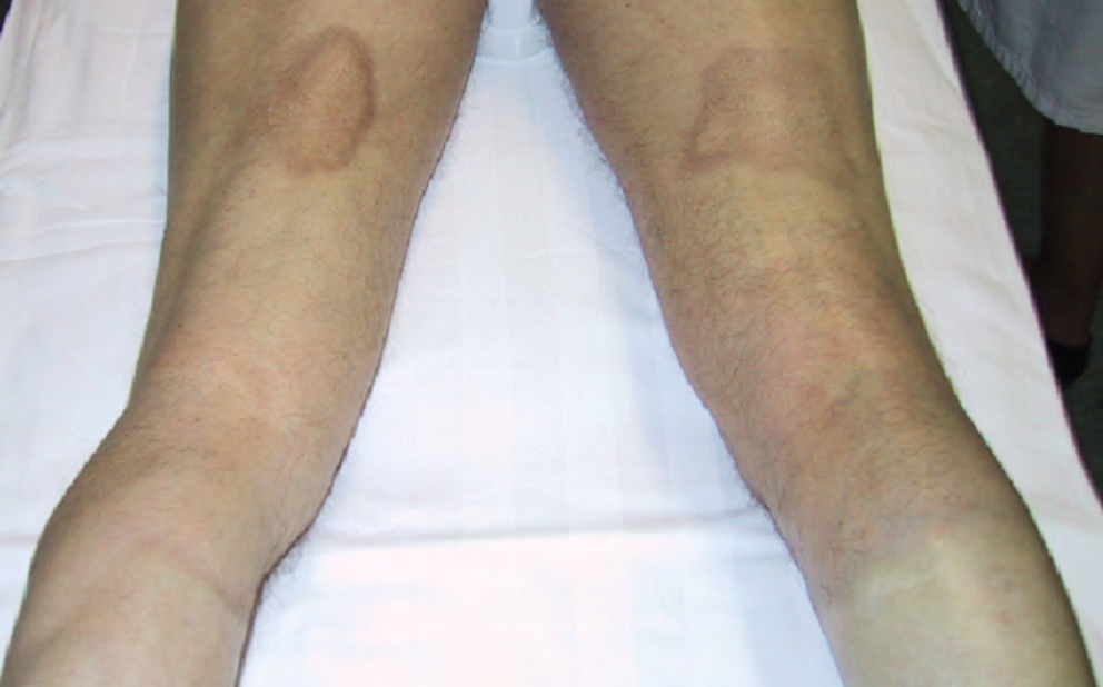 Endermologie for Scleroderma Scleroderma treatment