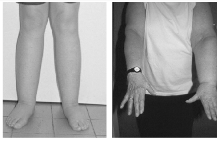 Lymphoedema