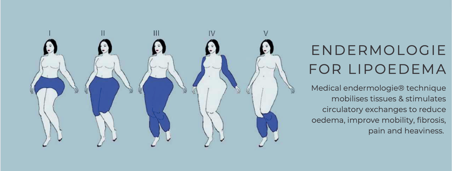 Endermologie for Lipoedema Endermologie treatment for lipoedema