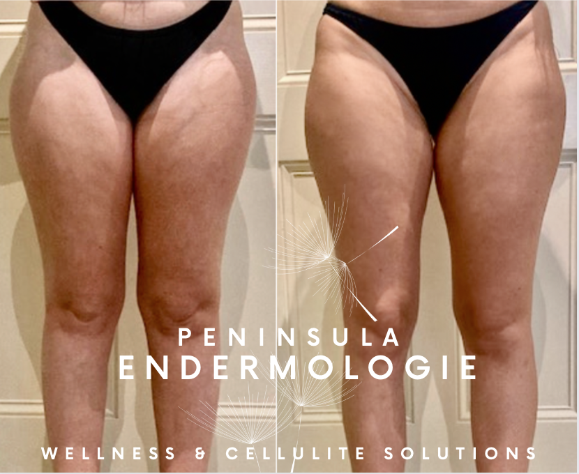 Before and After Endermologie treatments - Property of Peninsula Endermologie Before and After Endermologie photos