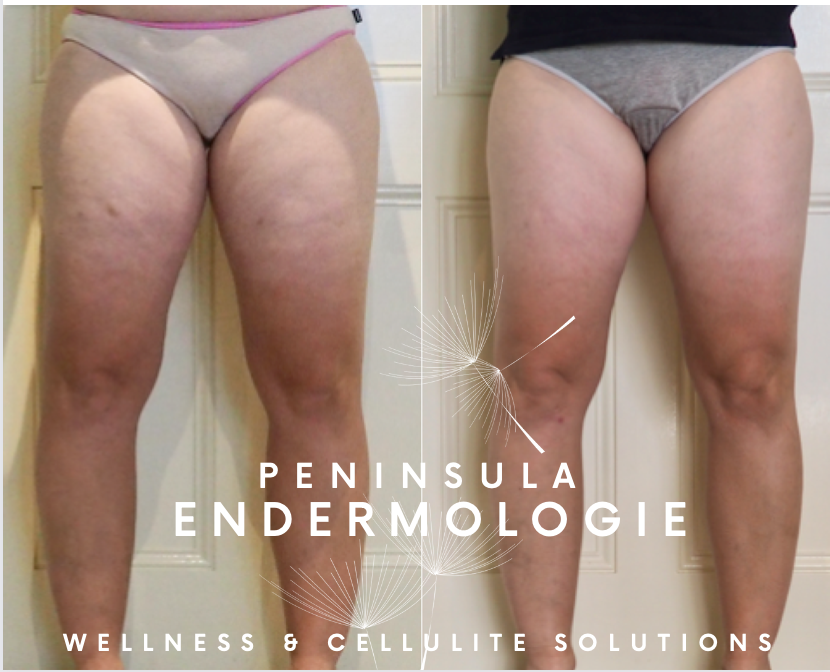 Results after 20 treatments with Endermologie - Property of Peninsula Endermologie Cellulite, body contouring and skin firming with Endermologie