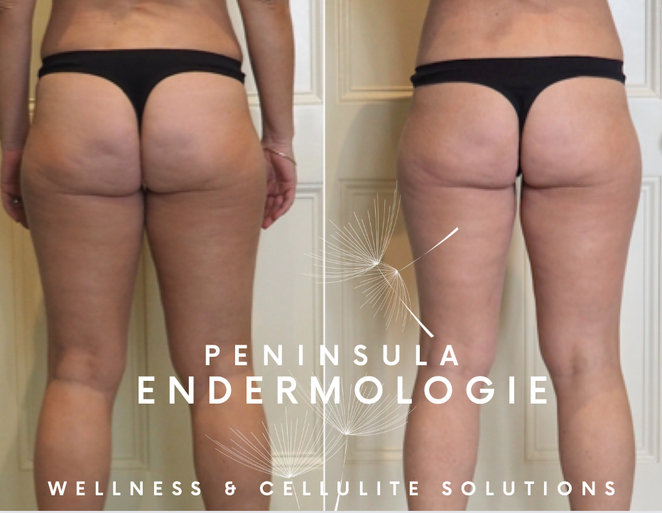 Cellulite, body contouring and skin firming with Endermologie - Property of Peninsula Endermologie Endermologie before and after photos - 20 treatments