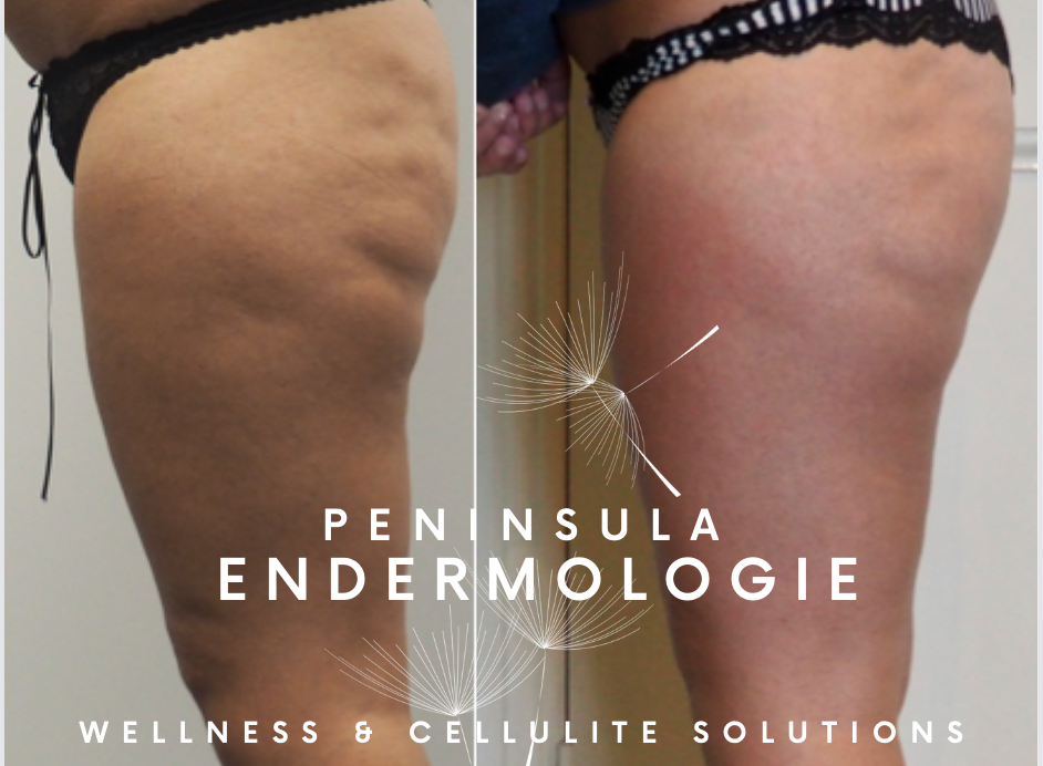 Before and after photos of severe cellulite & soft tissue damage. 20 treatments - Property of Peninsula Endermologie Before and After Endermologie cellulite treatment