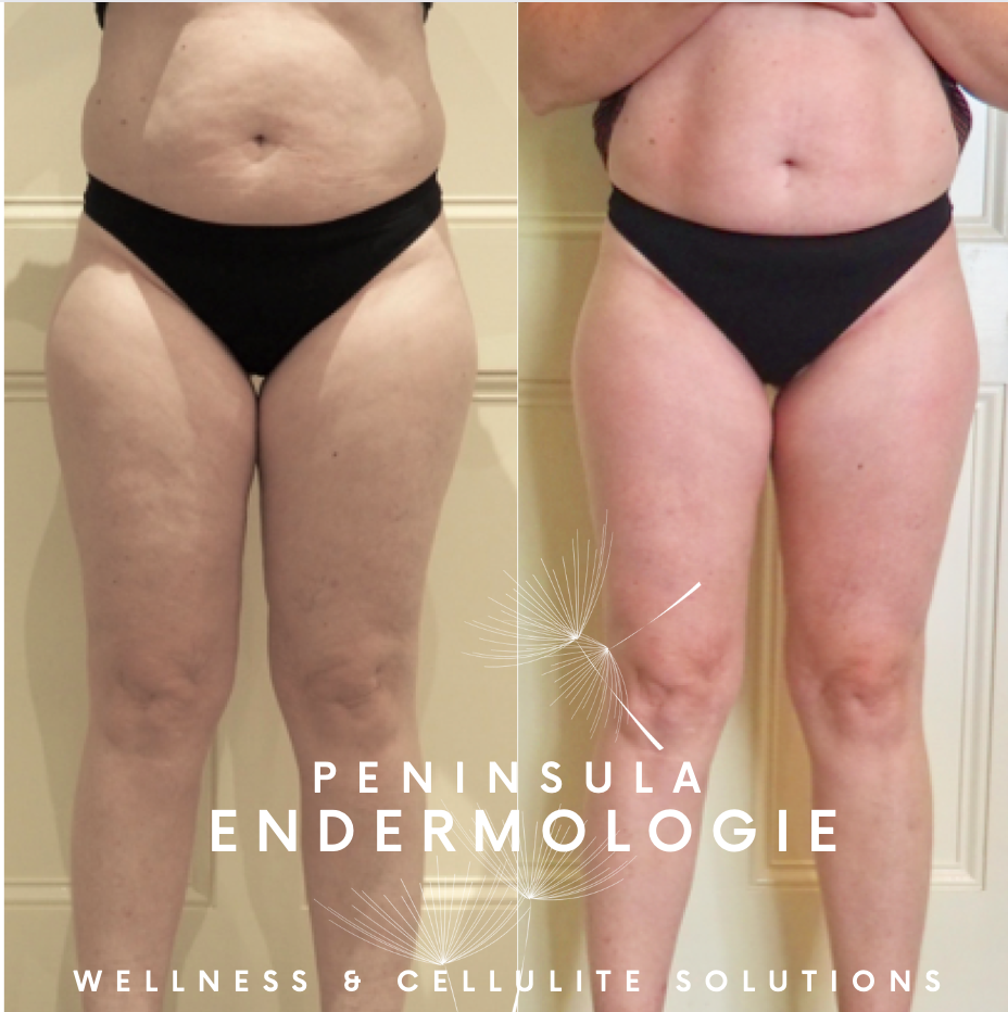 Full body before and after Endermologie photos . 20 treatments - Property of Peninsula Endermologie Before and After Endermologie full body treatment. Cellulite. Contouring. Skin Firming.
