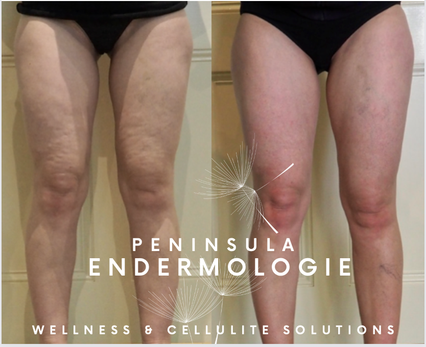 Endermologie skin firming before & after photos - Property of Peninsula Endermologie Endermologie before and after photos - approx. 20 treatments