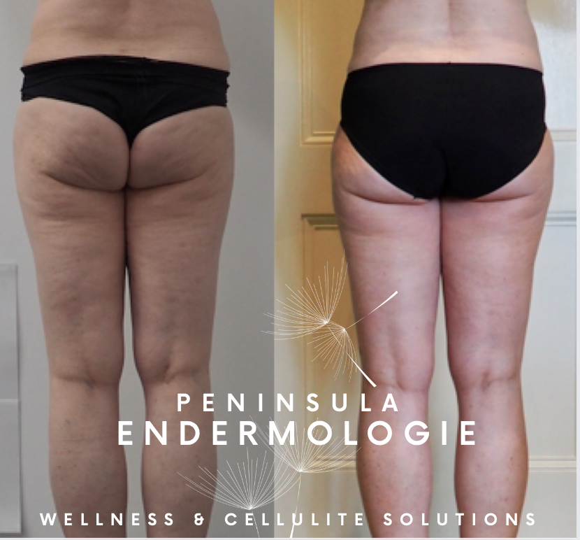 Before & after photos - Property of Peninsula Endermologie Results after approx. 20 Endermologie treatments