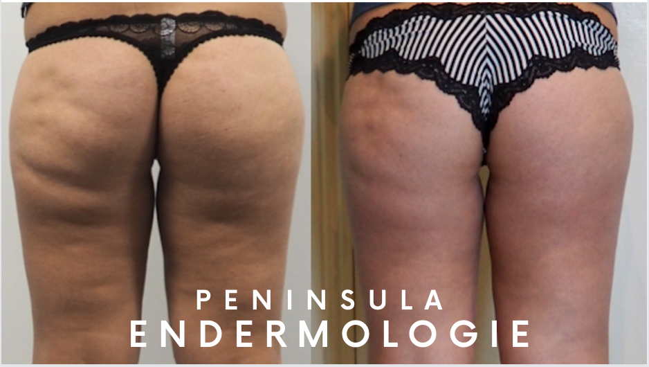 Endermologie before & after photos - soft tissue damage & cellulite - Property of Peninsula Endermologie Endermologie before and after photos - approx. 20 treatments